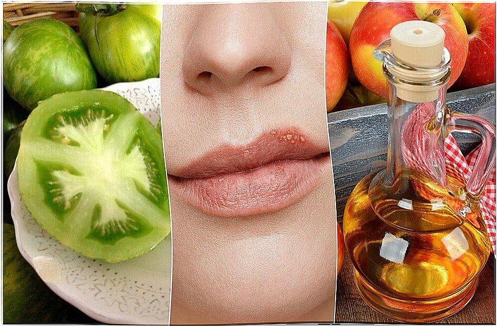 5 natural treatments for cold sores