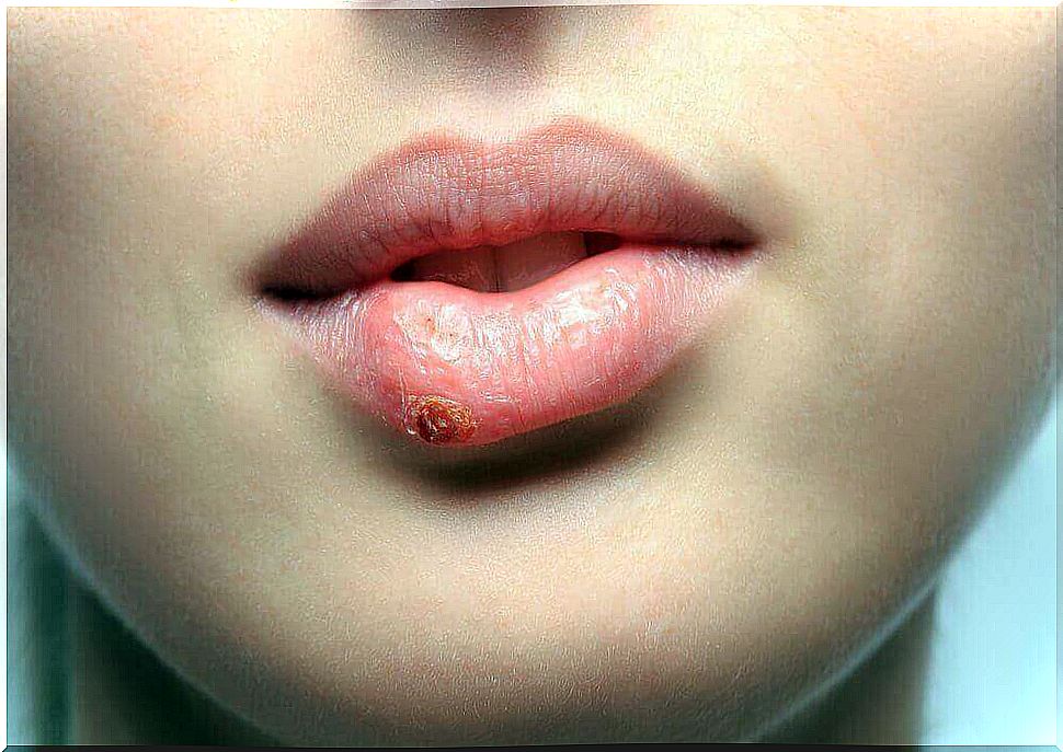 cold sores on a woman's lip