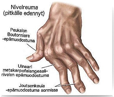 7 Natural Remedies For Hand Arthritis