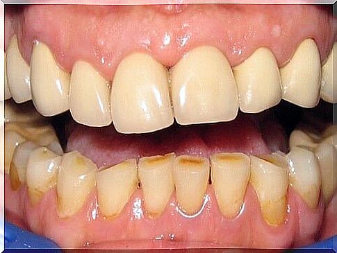 symptoms of dental inflammation: redness