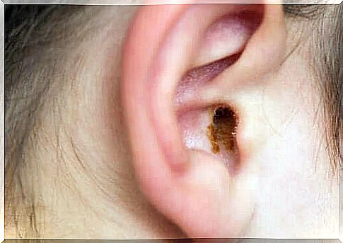 Ear wax obstruction and its symptoms