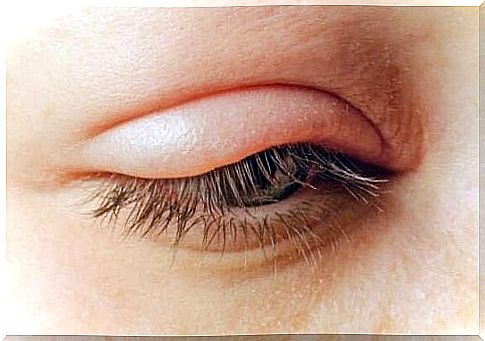 Eyelids: Causes, Symptoms and Treatment