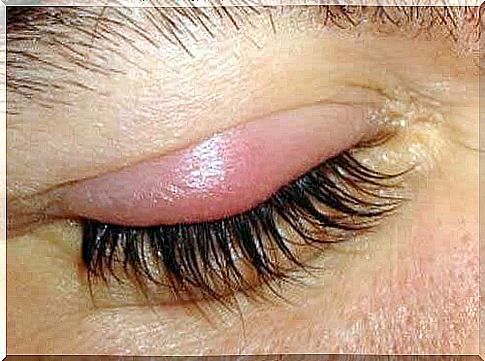 Eyelid inflammation causes the eyelid to become red and swollen