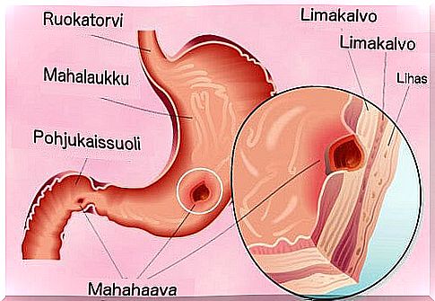 Treatment of gastric ulcer naturally