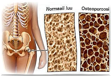 bone loss