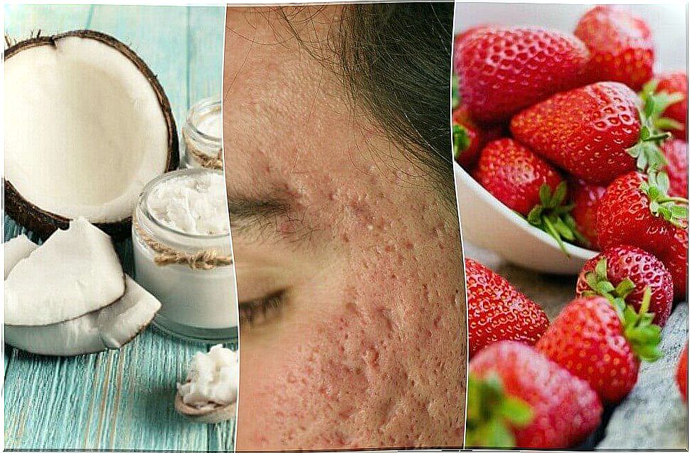 Home remedies for fading acne scars