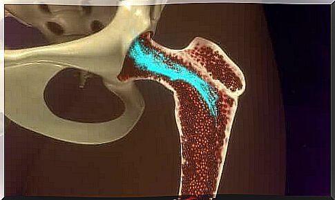 Symptoms of hypocalcaemia appear in the bones, among others