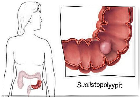 Intestinal polyps: what are they?