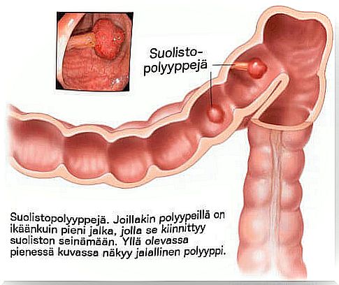 intestinal polyps