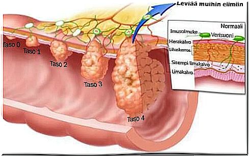 Levels of intestinal polyps