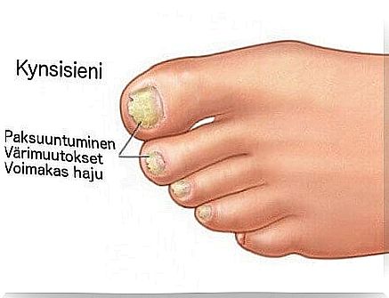 Treatment of nail fungus by natural means