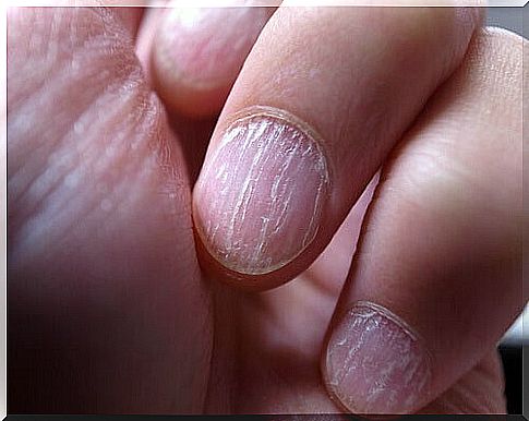 nail fungus on fingernails