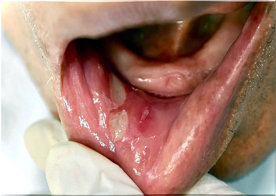 mouth ulcer on the lip