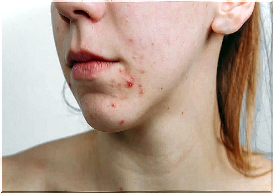 Pharmacological acne medications are either taken orally or topically.