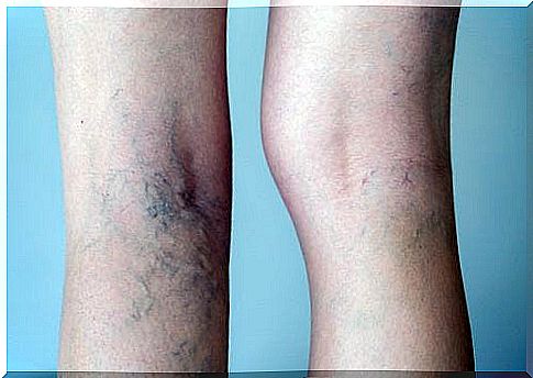 Treat varicose veins with medical extracts