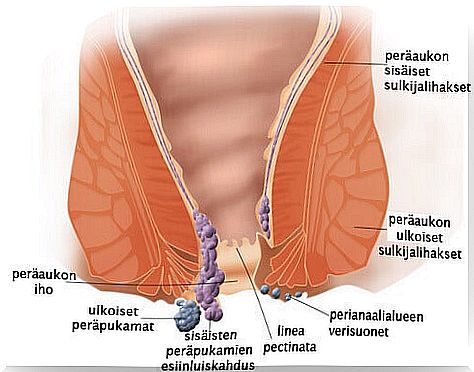 Hemorrhoids can occur for many reasons.