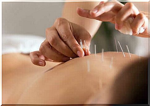 Drypointing is a procedure similar to acupuncture.