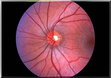 The papilledema is swelling of the optic nerve bump